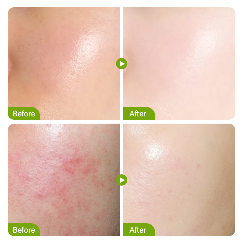 Salicylic Acid Acne Treatment  - مراجعة Salicylic Acid Cleanser وسعره